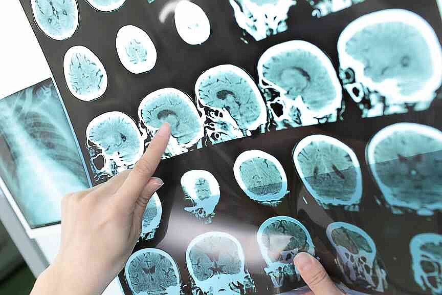 Mayo Clinic maps hidden biology of common brain tumors